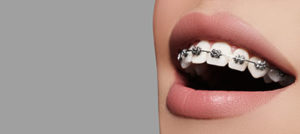 A young woman smiles, revealing her dental braces in TX