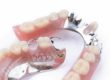 example of Hybrid Fixed Dentures