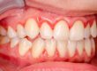 inside the mouth of a patient asking what is gingivitis