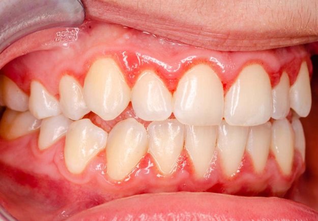what is gingivitis inside the mouth of a patient asking what is gingivitis