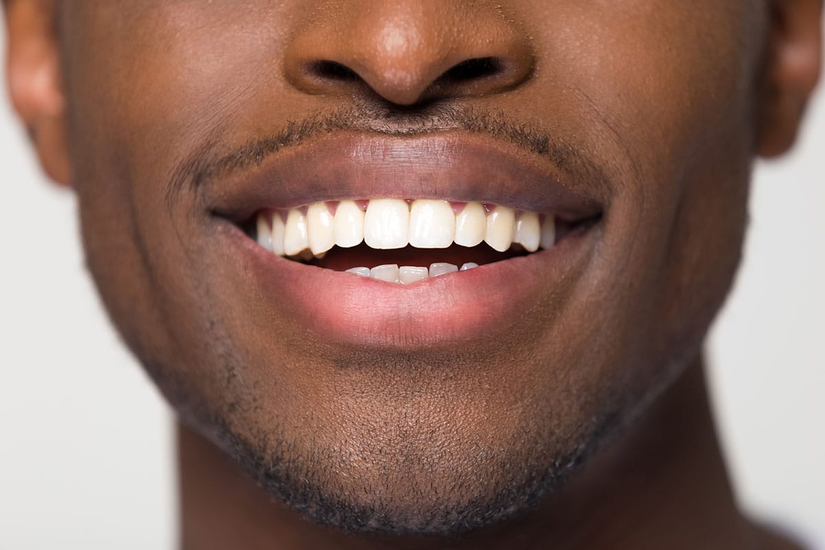 teeth whitening options a man smiles as he thinks about teeth whitening options