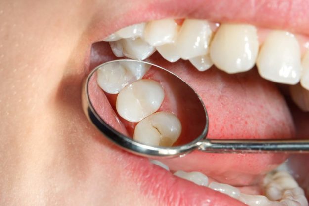 dental-sealants dentist checking teeth for dental sealants