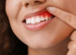 stages of gum disease texas