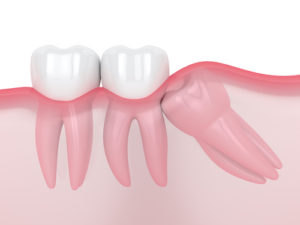 Diagram details what an impacted tooth looks like