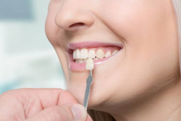 veneers-dental-procedures an example of dental veneers
