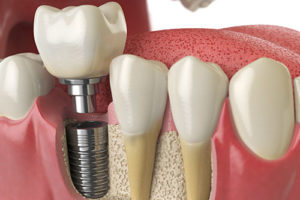 an example of putting in dental implants 