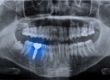how do dental implants work